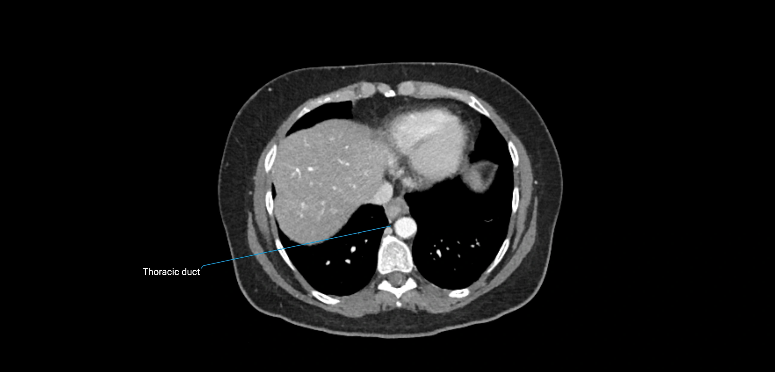 CT ct abdominal lymph nodes  axial cross sectional anatomy  enchanced radiology image -img-00002-00067.webp